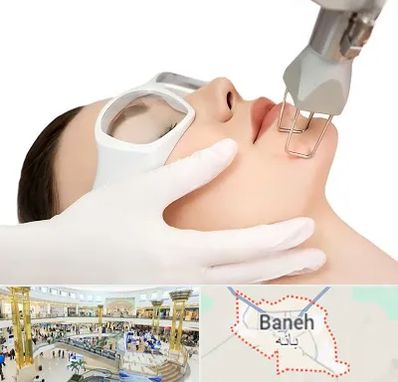لیزر فرکشنال در بانه