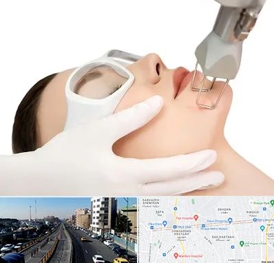 لیزر فرکشنال در پیروزی 