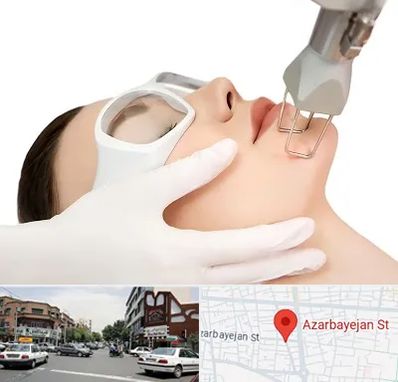 لیزر فرکشنال در خیابان آذربایجان