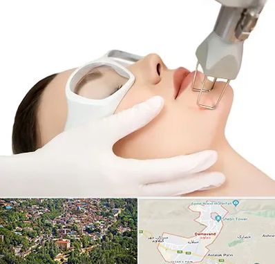 لیزر فرکشنال در دماوند