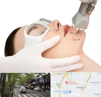 لیزر فرکشنال در ظفر 