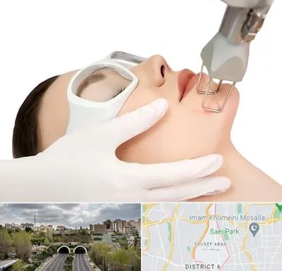 لیزر فرکشنال در یوسف آباد 