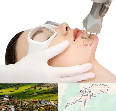 لیزر فرکشنال در کلاردشت