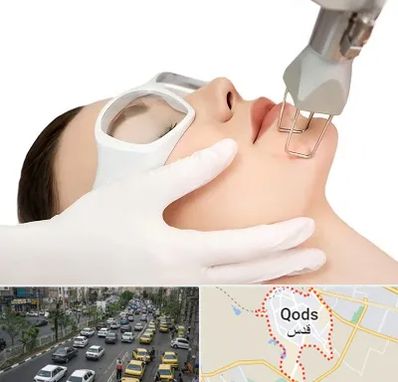 لیزر فرکشنال در شهر قدس