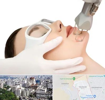 لیزر فرکشنال در ولنجک 