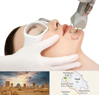 لیزر فرکشنال در یزد