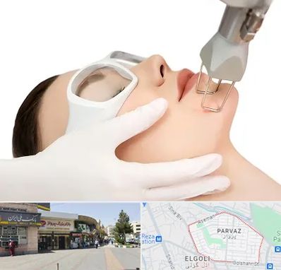 لیزر فرکشنال در پرواز تبریز