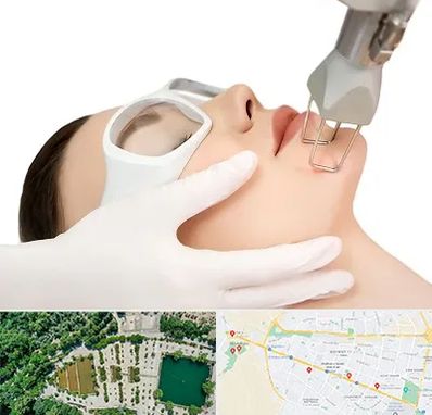 لیزر فرکشنال در وکیل آباد مشهد 