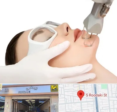 لیزر فرکشنال در رودکی