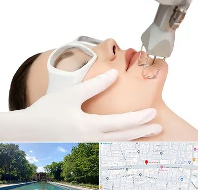 لیزر فرکشنال در هشت بهشت اصفهان