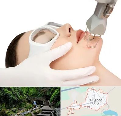 لیزر فرکشنال در علی آباد کتول