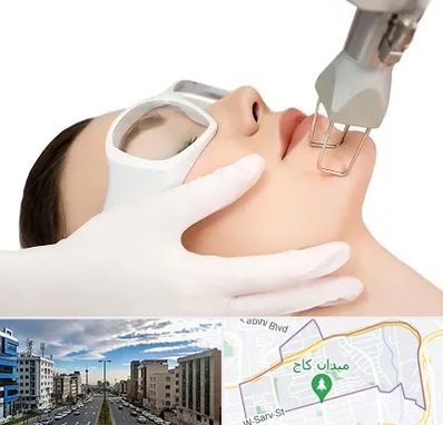 لیزر فرکشنال در سعادت آباد 