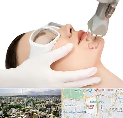 لیزر فرکشنال در گیشا 