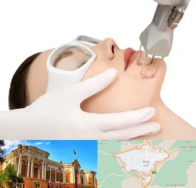 لیزر فرکشنال در خوی