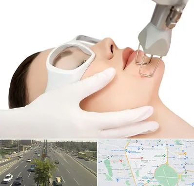 لیزر فرکشنال در منطقه 17 تهران 