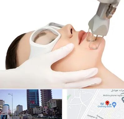 لیزر فرکشنال در چهارراه طالقانی کرج