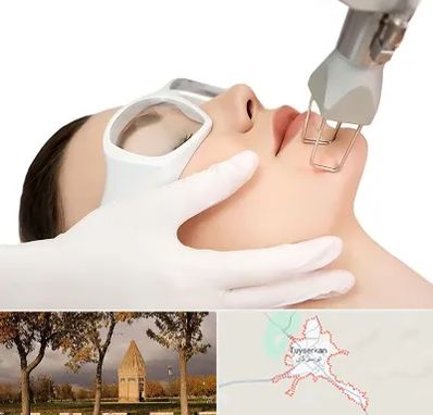 لیزر فرکشنال در تویسرکان