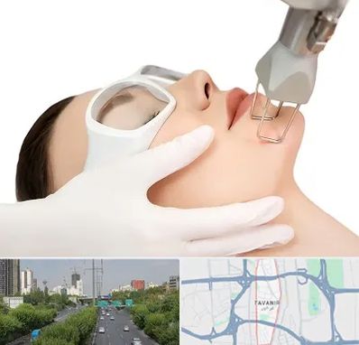 لیزر فرکشنال در توانیر