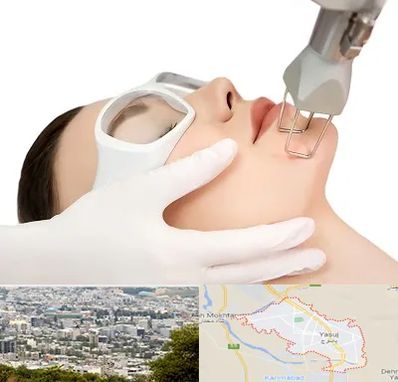 لیزر فرکشنال در یاسوج