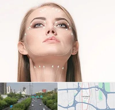 لیفت صورت با نخ در توانیر