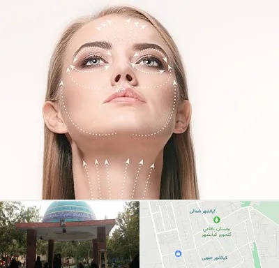 لیفت صورت با نخ در کیانشهر