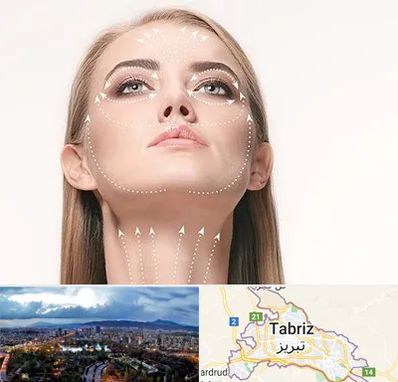 لیفت صورت با نخ در تبریز