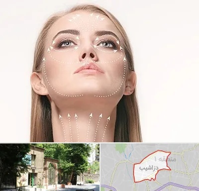 لیفت صورت با نخ در دزاشیب