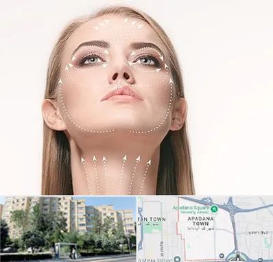 لیفت صورت با نخ در آپادانا