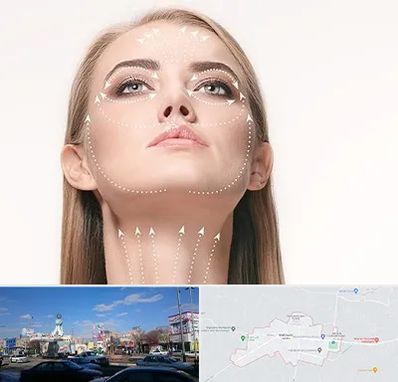 لیفت صورت با نخ در ماهدشت کرج 