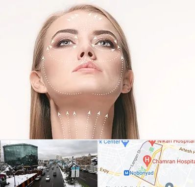 لیفت صورت با نخ در اقدسیه 