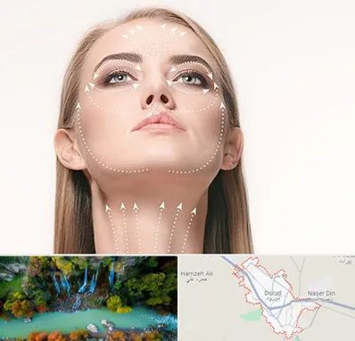 لیفت صورت با نخ در دورود