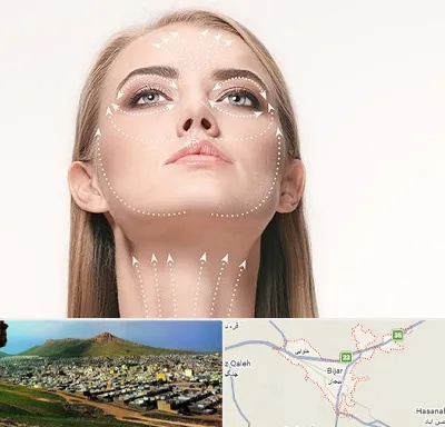 لیفت صورت با نخ در بیجار