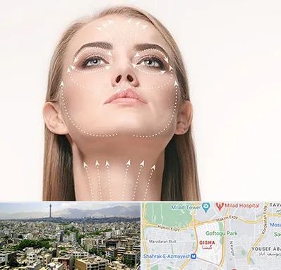 لیفت صورت با نخ در گیشا 