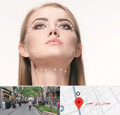 لیفت صورت با نخ در ولیعصر شهریار