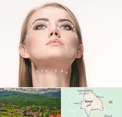 لیفت صورت با نخ در آمل