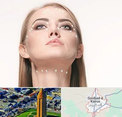 لیفت صورت با نخ در گنبد کاووس