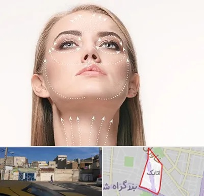 لیفت صورت با نخ در اتابک