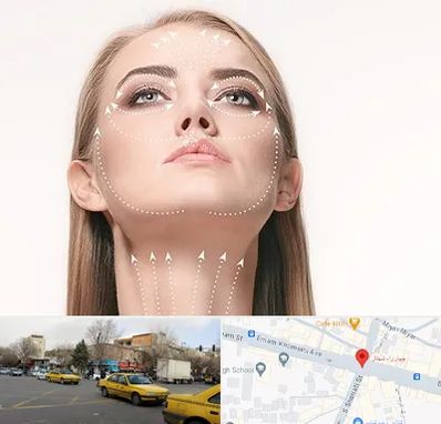 لیفت صورت با نخ در شهناز تبریز