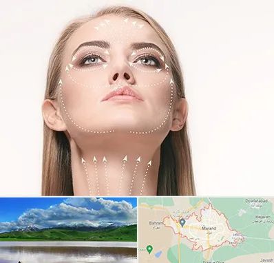 لیفت صورت با نخ در مرند