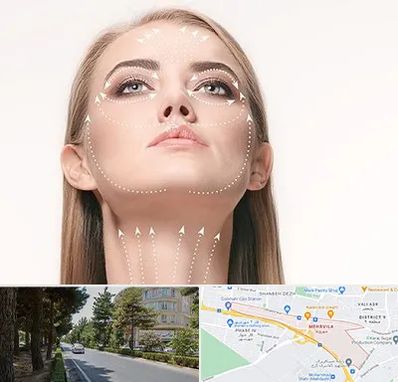 لیفت صورت با نخ در مهرویلا کرج