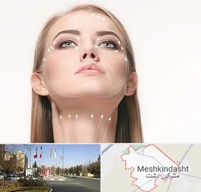 لیفت صورت با نخ در مشکین دشت