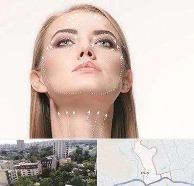 لیفت صورت با نخ در اوین