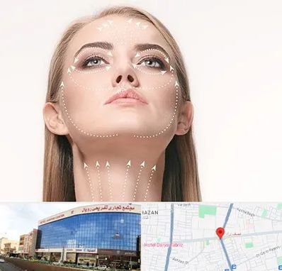 لیفت صورت با نخ در نصف راه تبریز