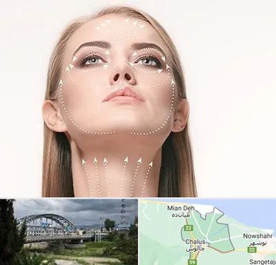 لیفت صورت با نخ در چالوس