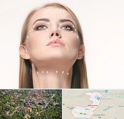 لیفت صورت با نخ در دماوند