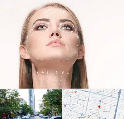 لیفت صورت با نخ در امامت مشهد