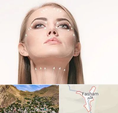 لیفت صورت با نخ در فشم