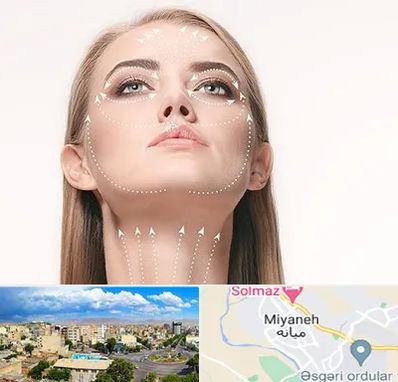 لیفت صورت با نخ در میانه