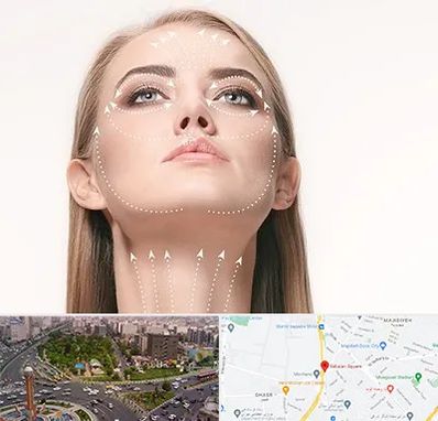 لیفت صورت با نخ در سبلان 