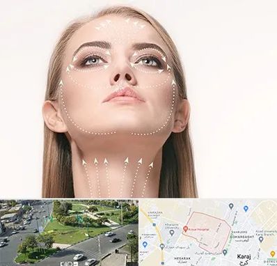 لیفت صورت با نخ در شاهین ویلا کرج